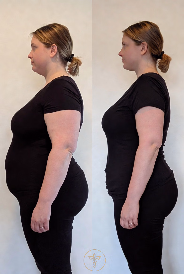glp-1_weight_loss_female_before_and_after_2_bodyloom_wellness_frisco