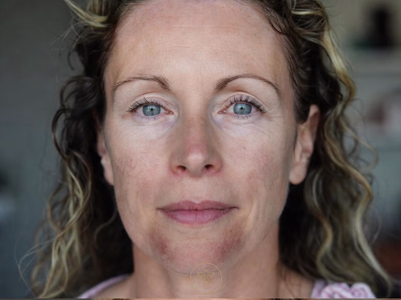 rf_microneedling_before_and_after_bodyloom_wellness_frisco_pair_1_1_of_2