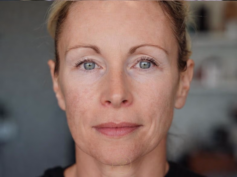 rf_microneedling_before_and_after_bodyloom_wellness_frisco_pair_1_2_of_2