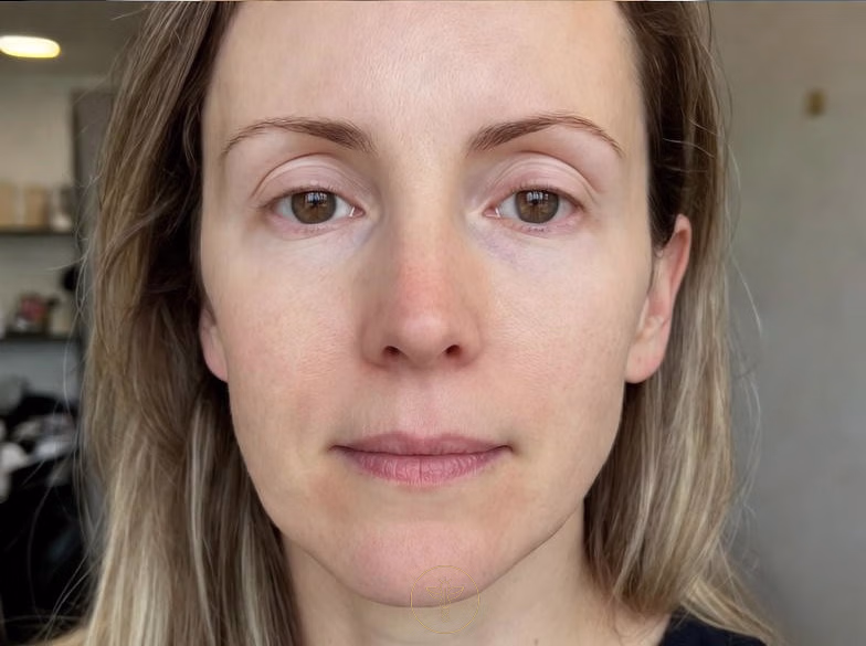 rf_microneedling_before_and_after_bodyloom_wellness_frisco_pair_2_2_of_2