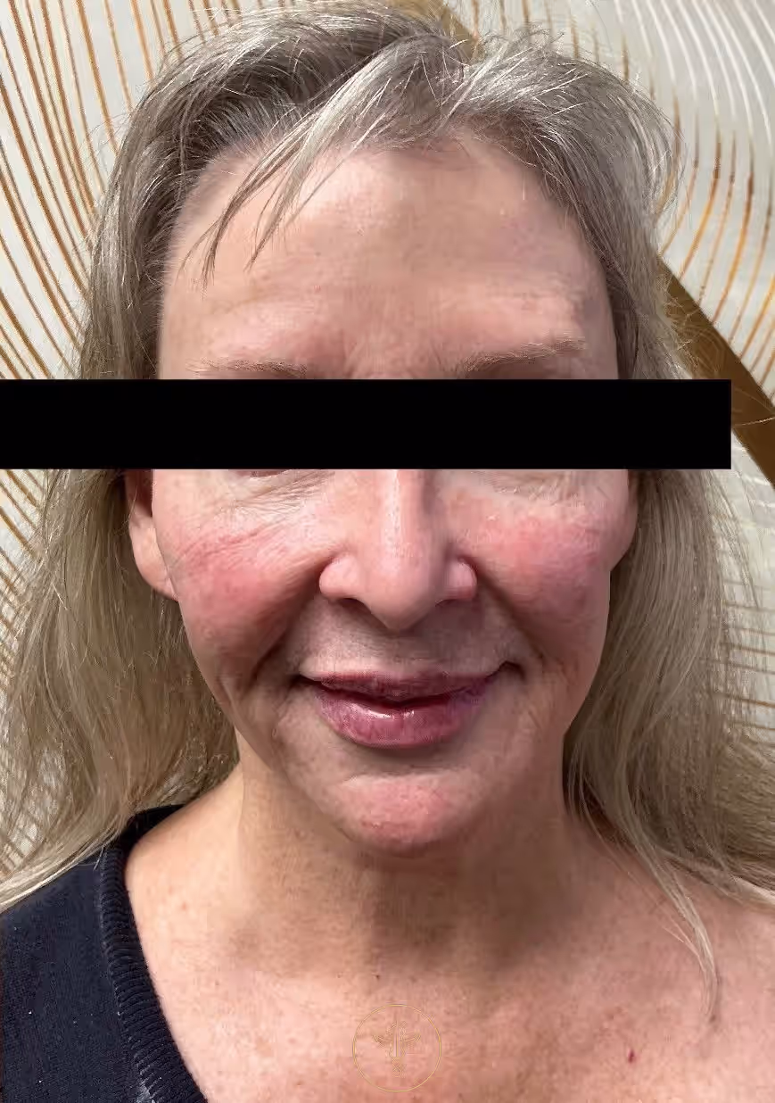 after-lip-filler-and-cheek-filler-at-bodyloom-8