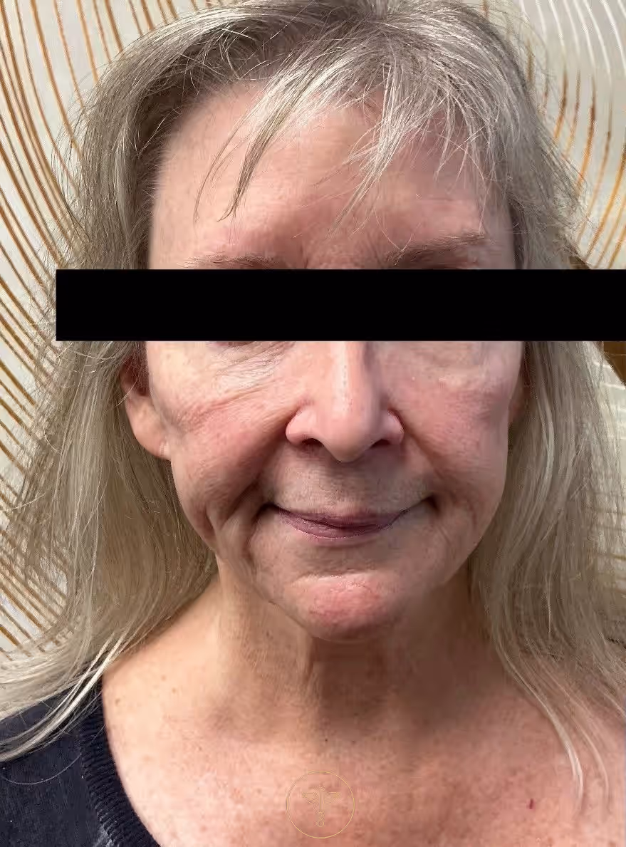 before-lip-filler-and-cheek-filler-at-bodyloom-9