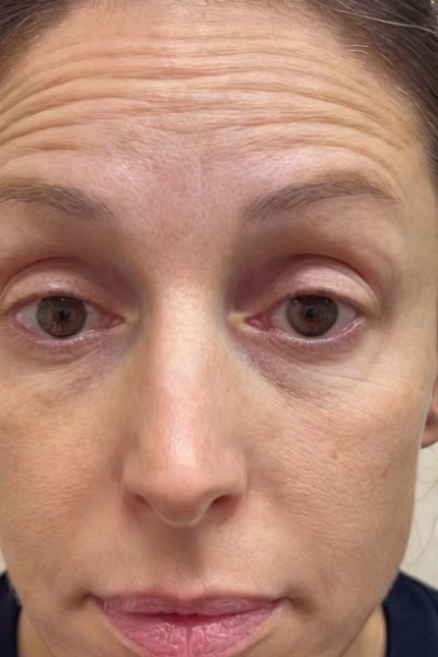 botox and juvederm skinvive before and after patient 1 - bodyloom wellness frisco