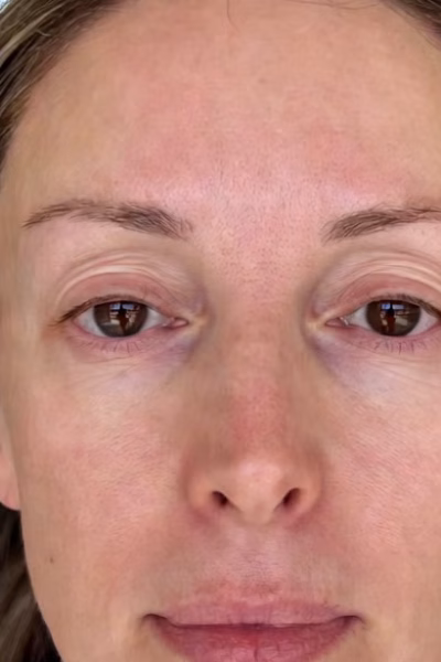 botox and juvederm skinvive before and after patient 1 - bodyloom wellness frisco